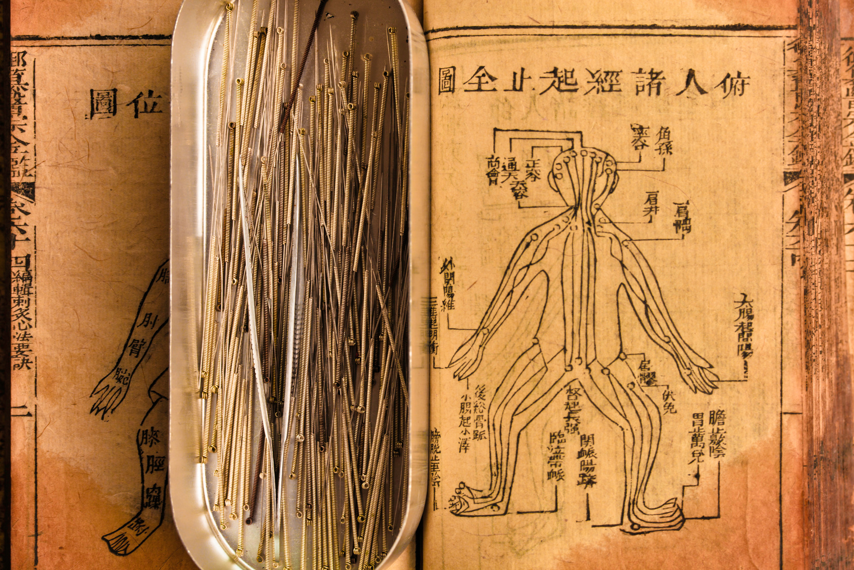 acupuncture needle